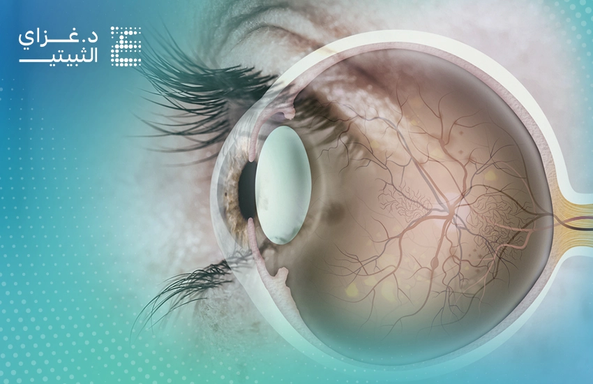 اعتلال الشبكية