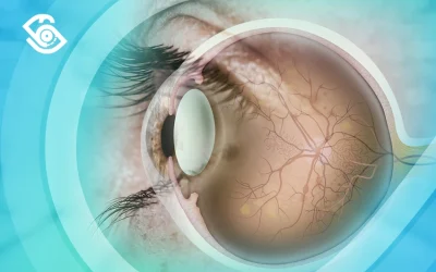 كل ما تحتاج معرفته عن اعتلال الشبكية