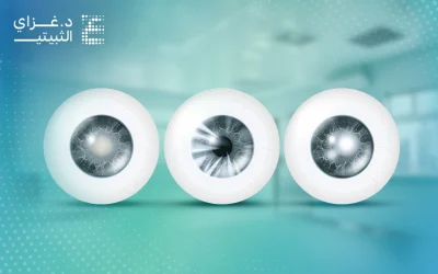 ما أنواع الماء الأبيض في العين؟