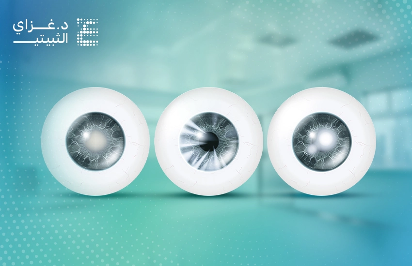 أنواع الماء الأبيض في العين
