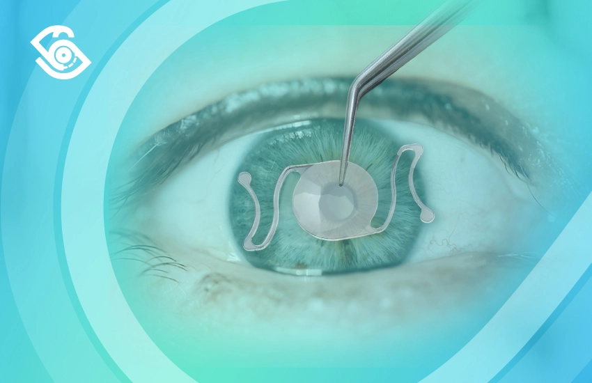 عملية زراعة عدسة العين عملية زراعة عدسة العين