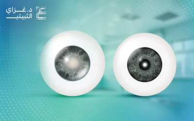 ما الفرق بين المياه البيضاء والزرقاء في العين؟ 