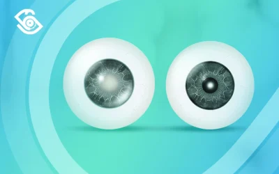 ما الفرق بين المياه البيضاء والزرقاء في العين؟ 