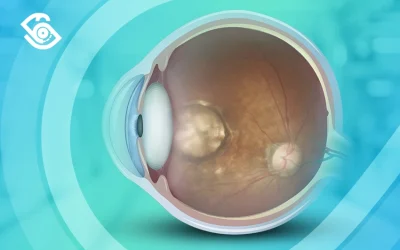 ما هو الثقب البقعي في العين وكيف يؤثر في الرؤية؟