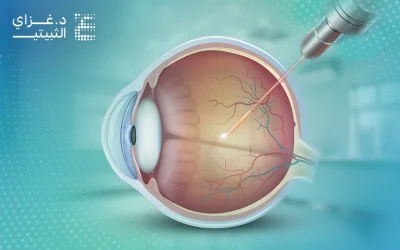 علاج الشبكية بالليزر: إجراء هام للحفاظ على سلامة النظر