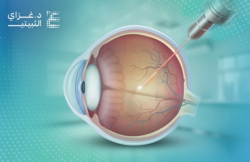 علاج الشبكية بالليزر